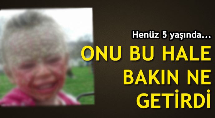 Güneşe alerjisi var!