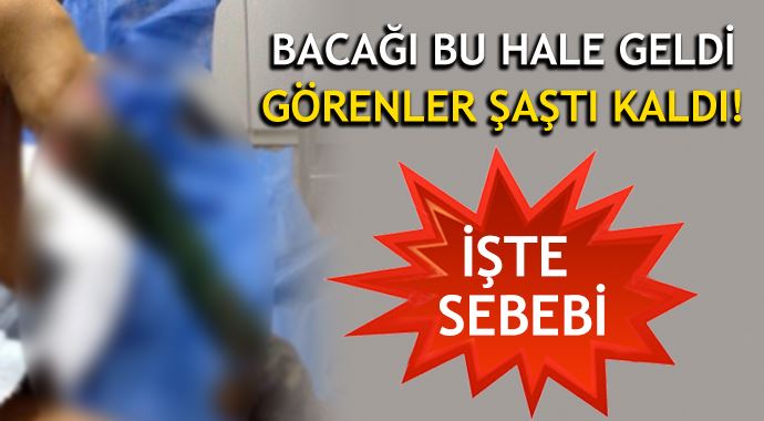 Yılan ısırığı bu hale getirdi! Bacağı çürüdü