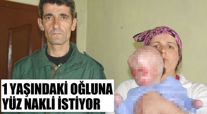 Bir yaşındaki oğluna yüz nakli istiyor