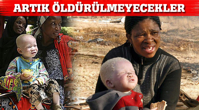 Tanzanyalı albinolar artık öldürülmeyecekler