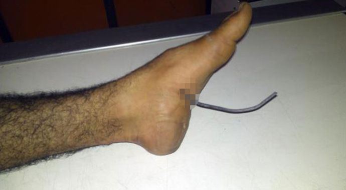 Yolda yürürken ayağı bu hale geldi