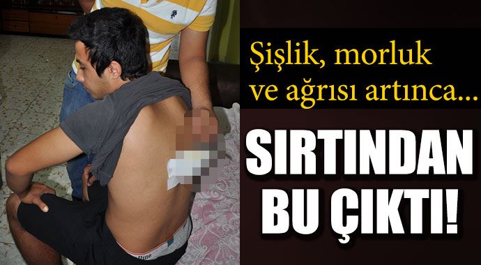 2,5 ay sonra fark etti, sırtından bu çıktı! 2,5 ay sonra fark etti, sırtından bu çıktı!