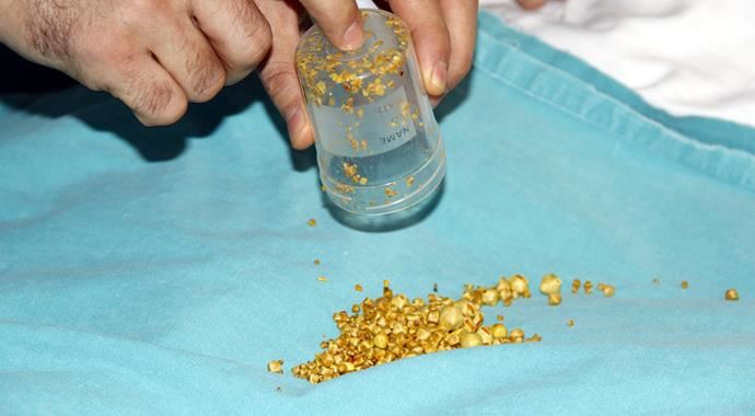 Safra kesesinden 704 taş çıktı Safra kesesinden 704 taş çıktı