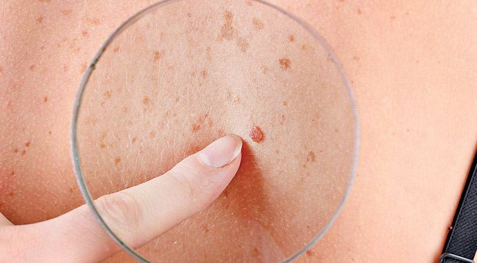 Benlerde çirkin ördek belirtisine dikkat Benlerde çirkin ördek belirtisine dikkat