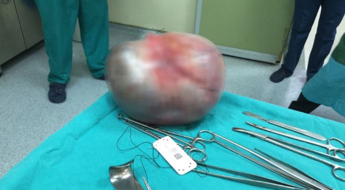 Bu bir insanın karnından çıktı, tam 4 kilo! Bu bir insanın karnından çıktı, tam 4 kilo!
