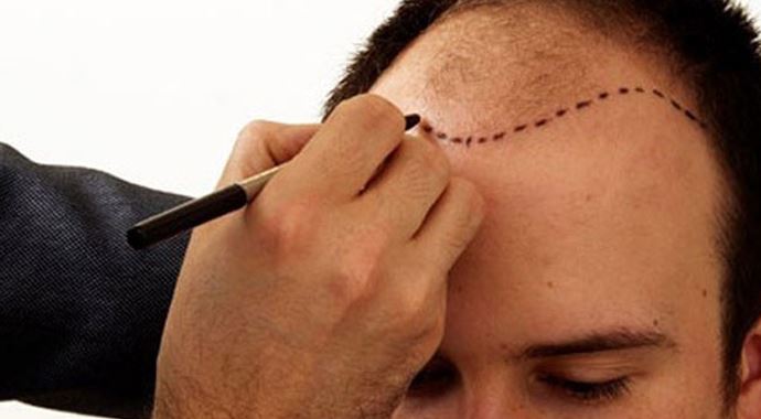 Saç ekimi ne zaman yapılmalı?