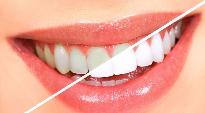 Dişleri beyazlatmanın püf noktası! Dişleri beyazlatmanın püf noktası!