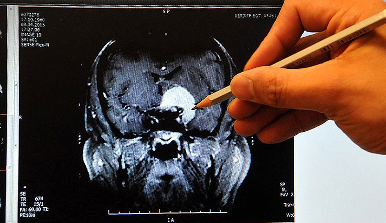 Covid en çok 'pıhtı' ile öldürüyor Covid en çok 'pıhtı' ile öldürüyor