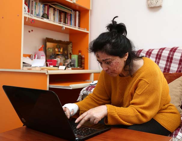 Cilt kanserine yakalanan kadın dışarı çıkamıyor