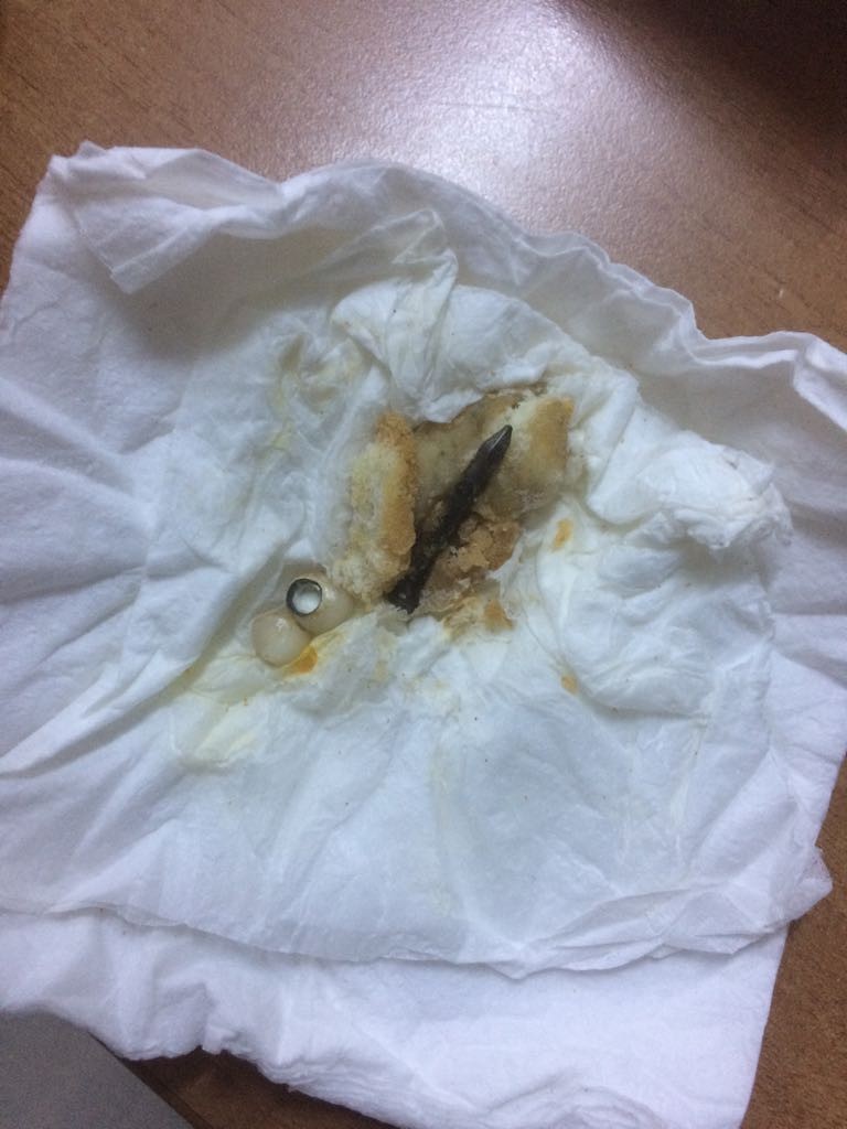 Pidenin içinden çıkan 3,5 cm'lik çivi 4 dişini kırdı