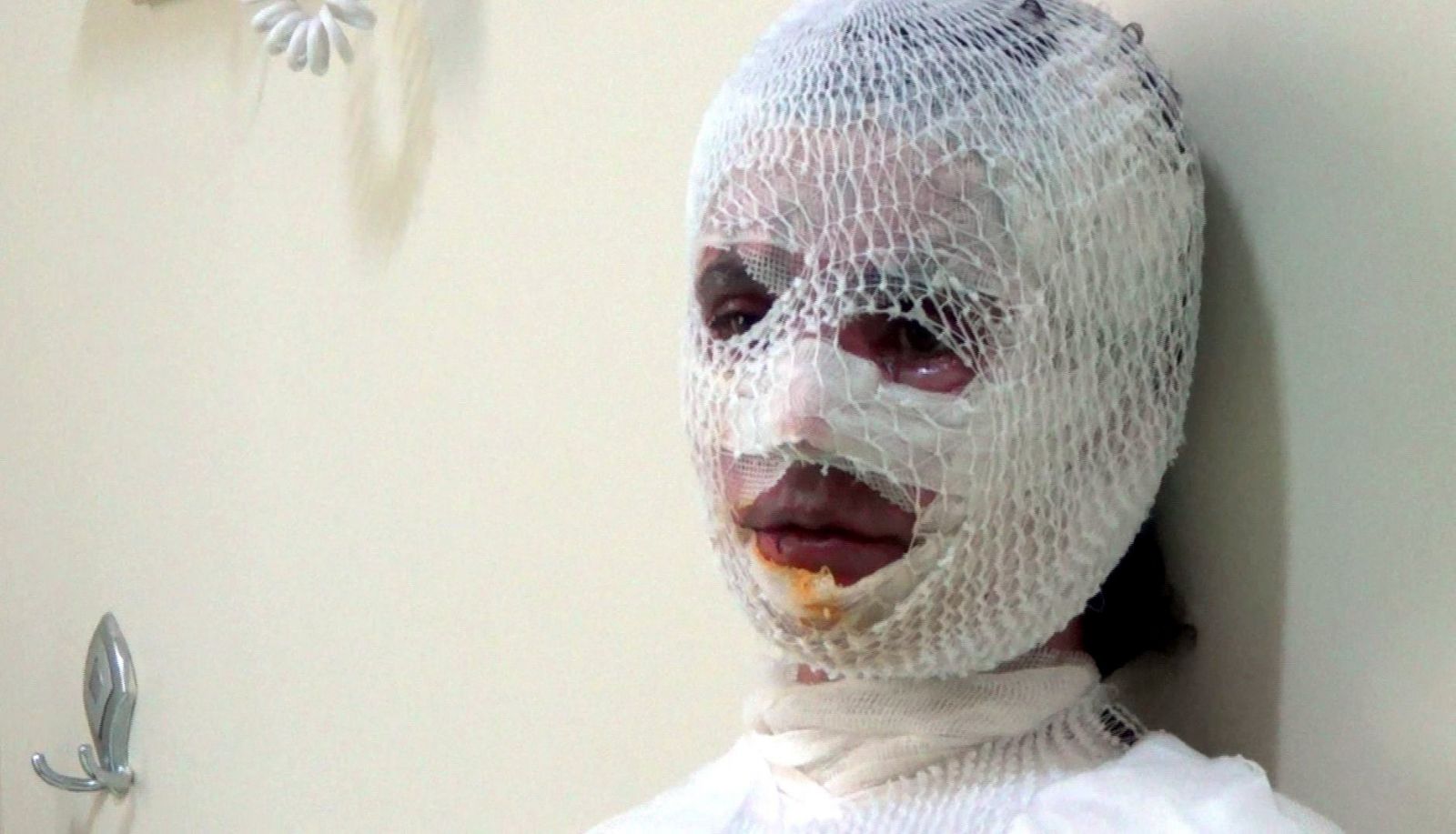 Üzerine kaynar su dökülen 8 çocuk annesi kadın bu hale geldi!