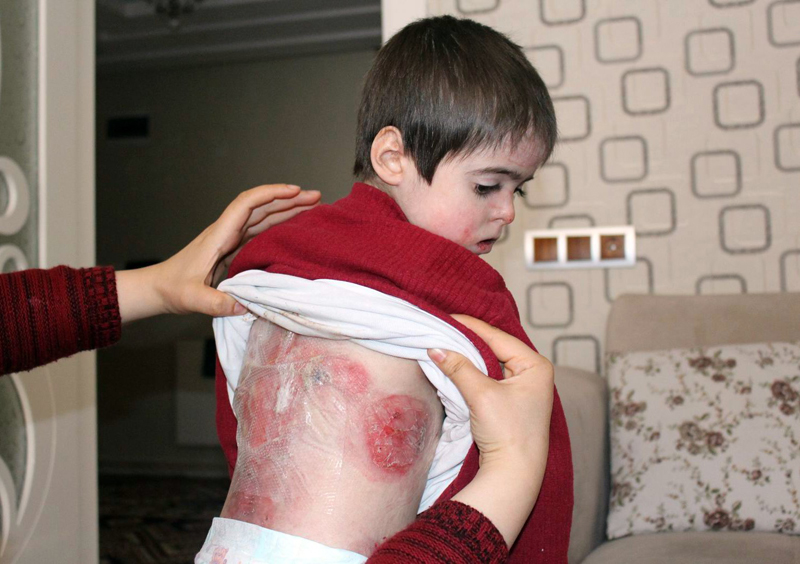 Milyonda bir görülen hastalık bu kadının 2 çocuğunda da var!