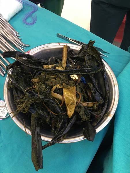 Çocuğun karnında 2 kilo cisim çıkarıldı