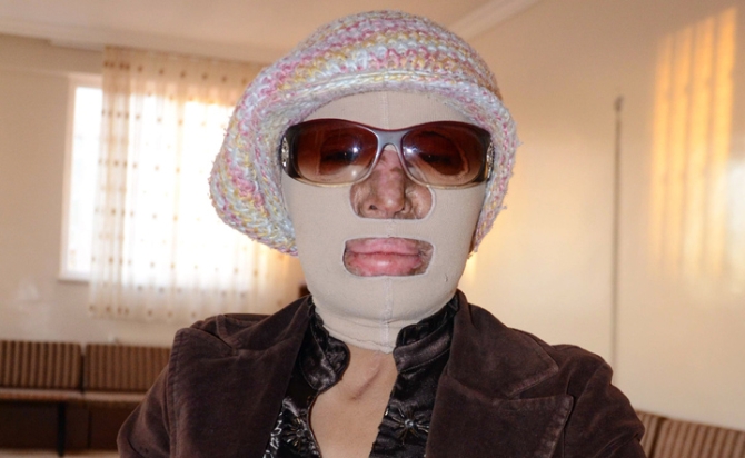 Evinde çıkan yangından sonra bu hale geldi!