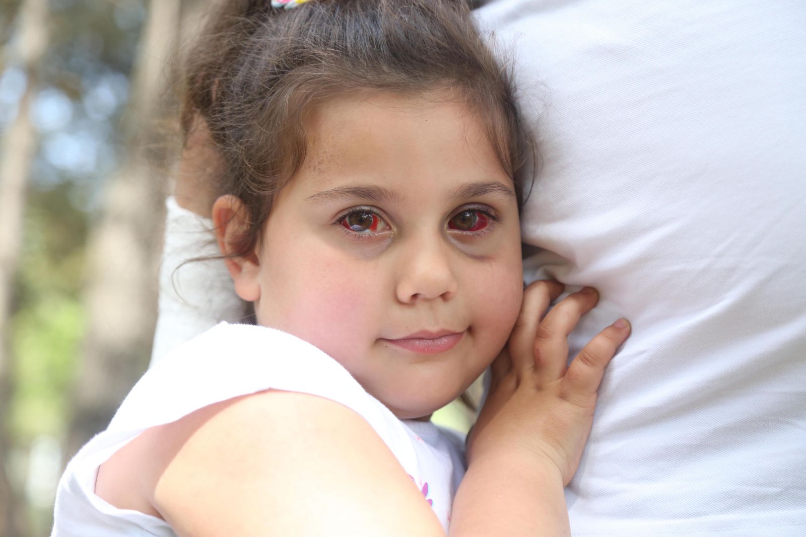 Eğlenmek isterken gözleri bu hale geldi!