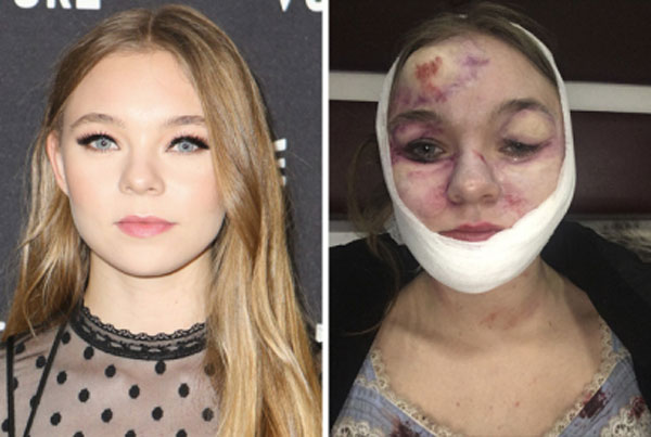 Ünlü oyuncu Taylor Hickson sette kaza geçirdi!