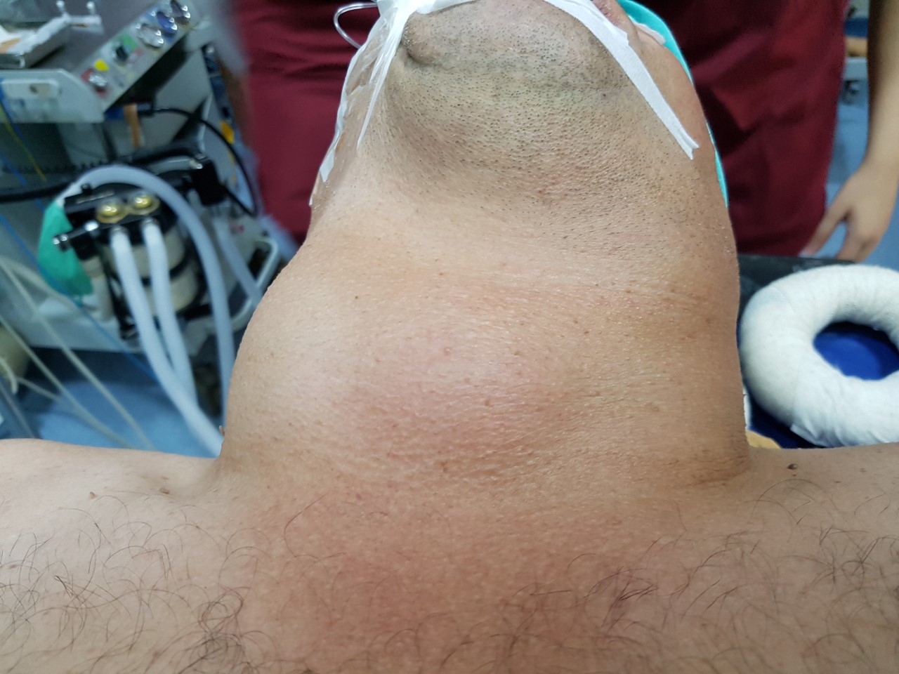 Boğazından 2 kilogram kitle çıkarıldı