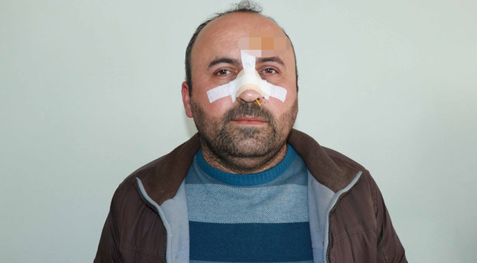 Ekmek kavgasında burnu kırıldı