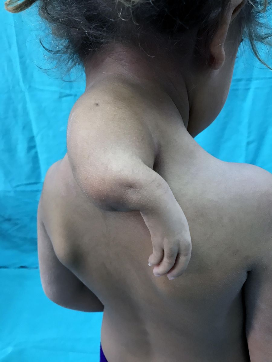 3 kollu doğan Hülya'nın sırtındaki kolu alındı!