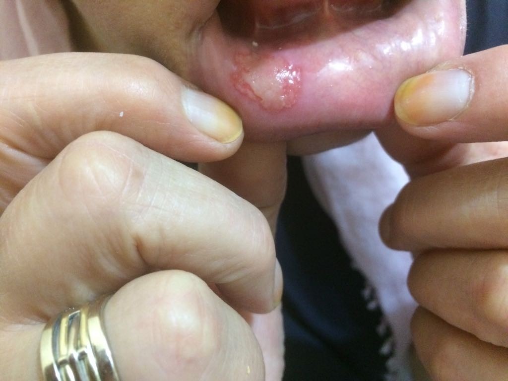 Pidenin içinden çıkan 3,5 cm'lik çivi 4 dişini kırdı