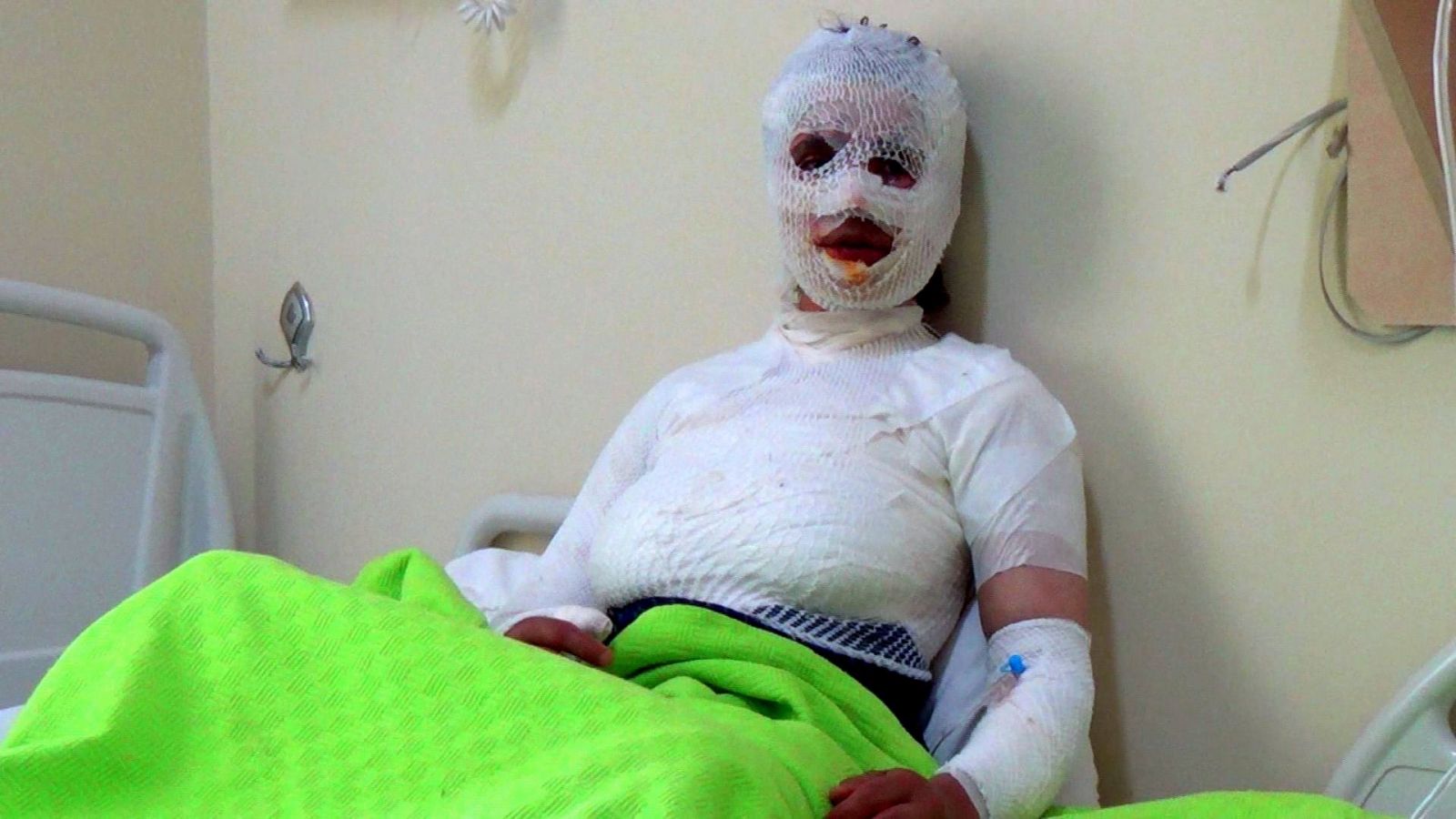 Üzerine kaynar su dökülen 8 çocuk annesi kadın bu hale geldi!