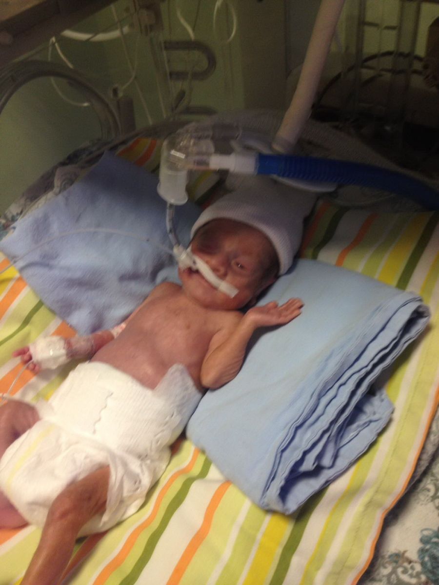 600 gram olarak doğdu, hayata tutundu