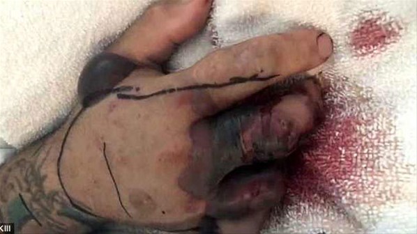 ABD'de kesik çıngıraklı yılan kafası bir adamı ısırdı
