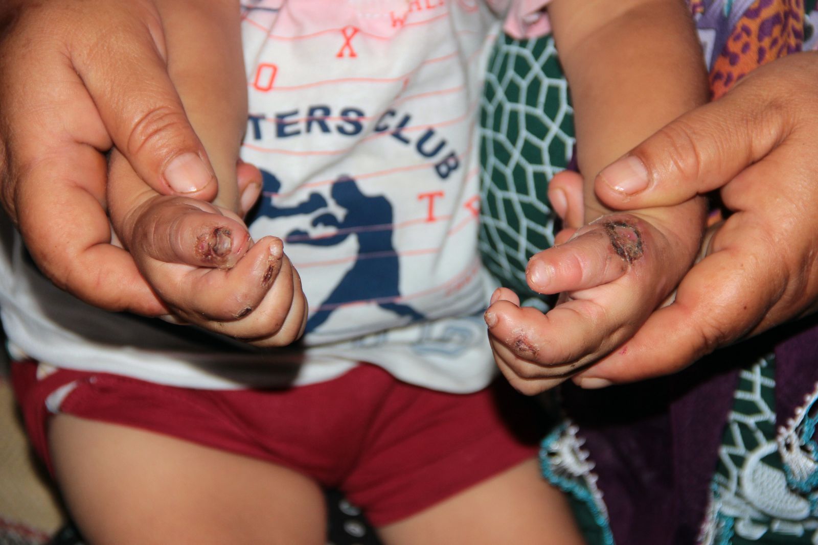 Isırarak kendine zarar veren bebeğin ailesi yardım istiyor