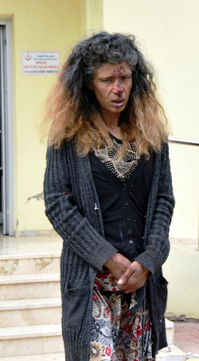 Kadını dövüp burnunu kırdılar