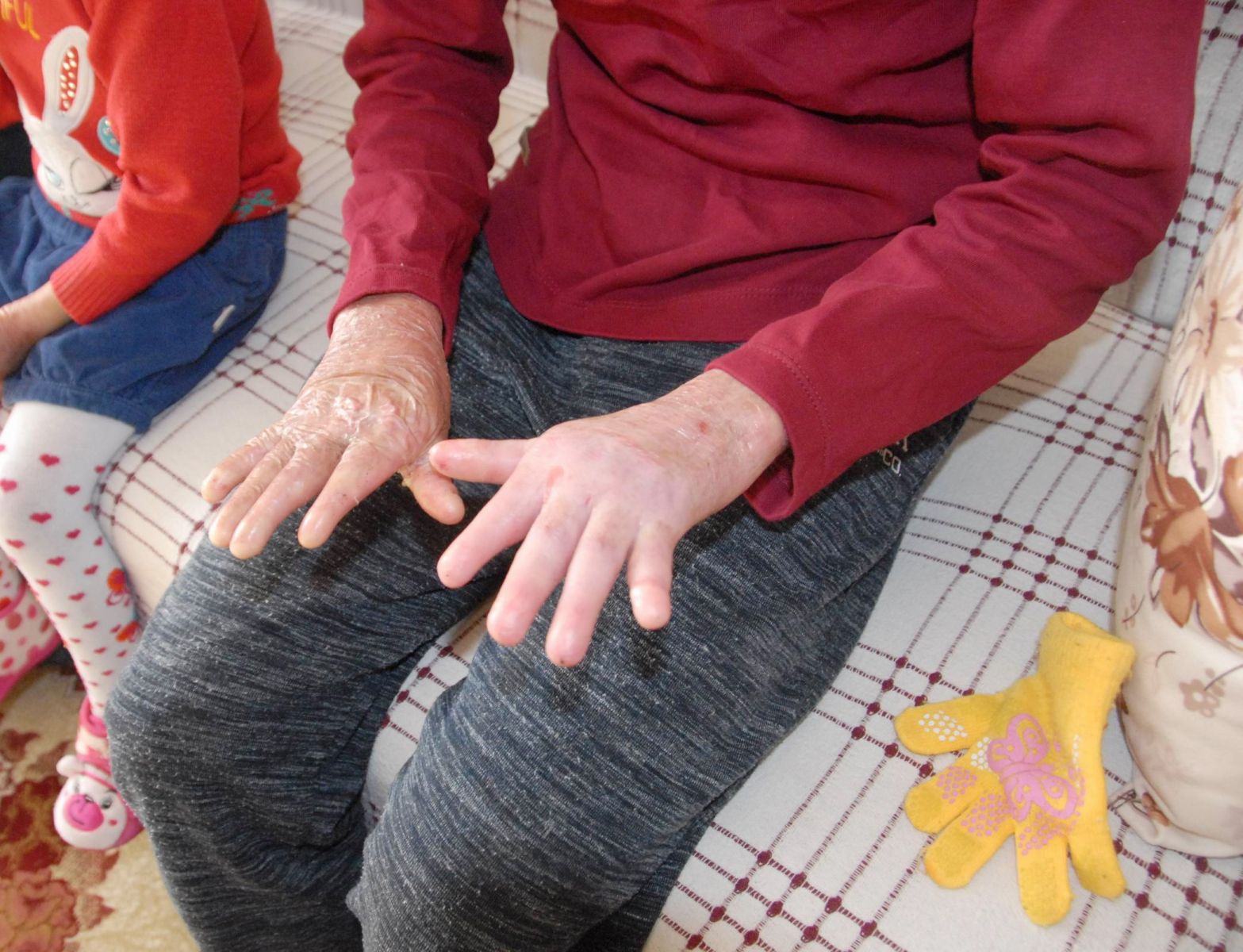 Kelebek hastası gencin en büyük hayali okumak