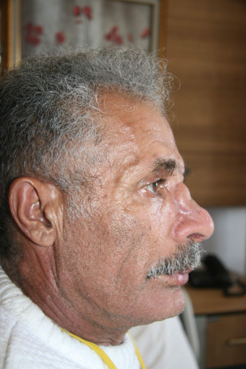 Kaburgasından burun yaptılar!