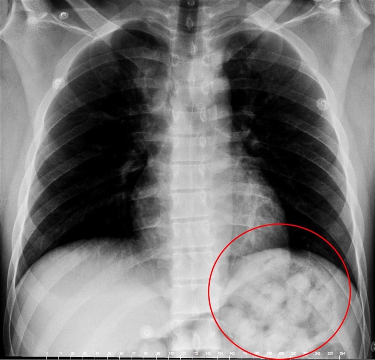 İran uyruklu uyuşturucu şüphelisinin midesinden 900 gram uyuşturucu çıktı