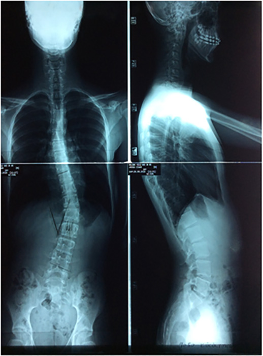 Skolyoz nedir, Skolyoz nasıl tedavi edilir? (Skolyoz Tedavi)