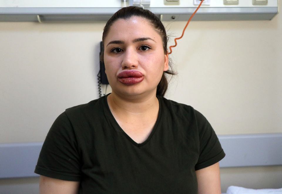 Silikon mağduru Merve hemşirenin son hali