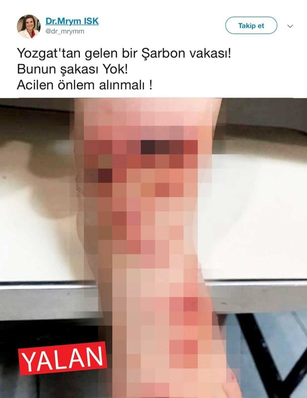 Şarbon değil FETÖ virüsü çıktı!