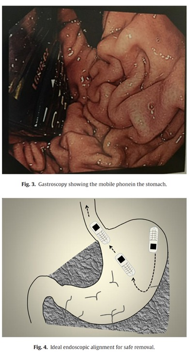 İnanılır gibi değil! Bu adam cep telefonunu yuttu