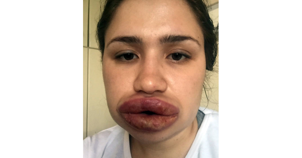 Silikondan dudaklarını kaybetmek üzere olan hemşirenin son hali