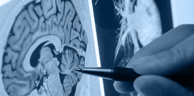 İnmede kritik eşik ilk 3 saat (İnme Nedir, Nasıl Olur? İnme Belirtileri Nelerdir?)