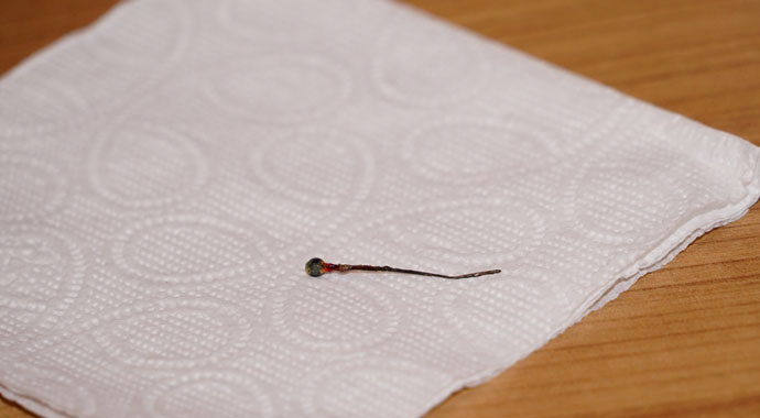 Öksürük şikayetiyle geldi hastaneye gelen kadının akciğerinden toplu iğne çıktı