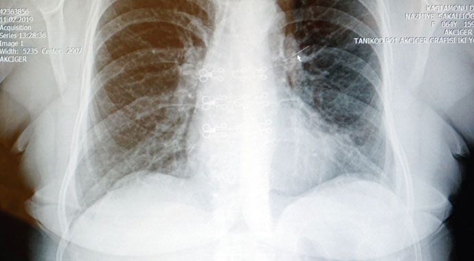 Öksürük şikayetiyle geldi hastaneye gelen kadının akciğerinden toplu iğne çıktı