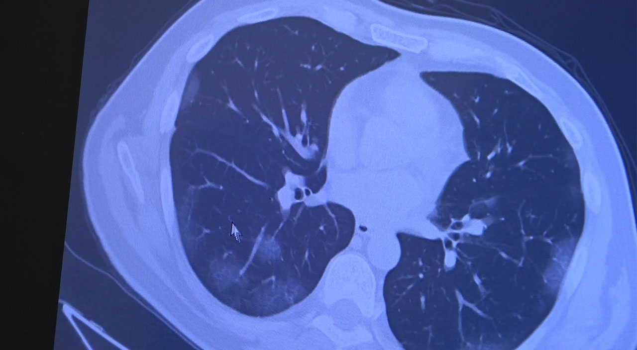Uzmanından rahatlatan açıklama: Aşı olanlarda ‘Omicron’ akciğere inmiyor