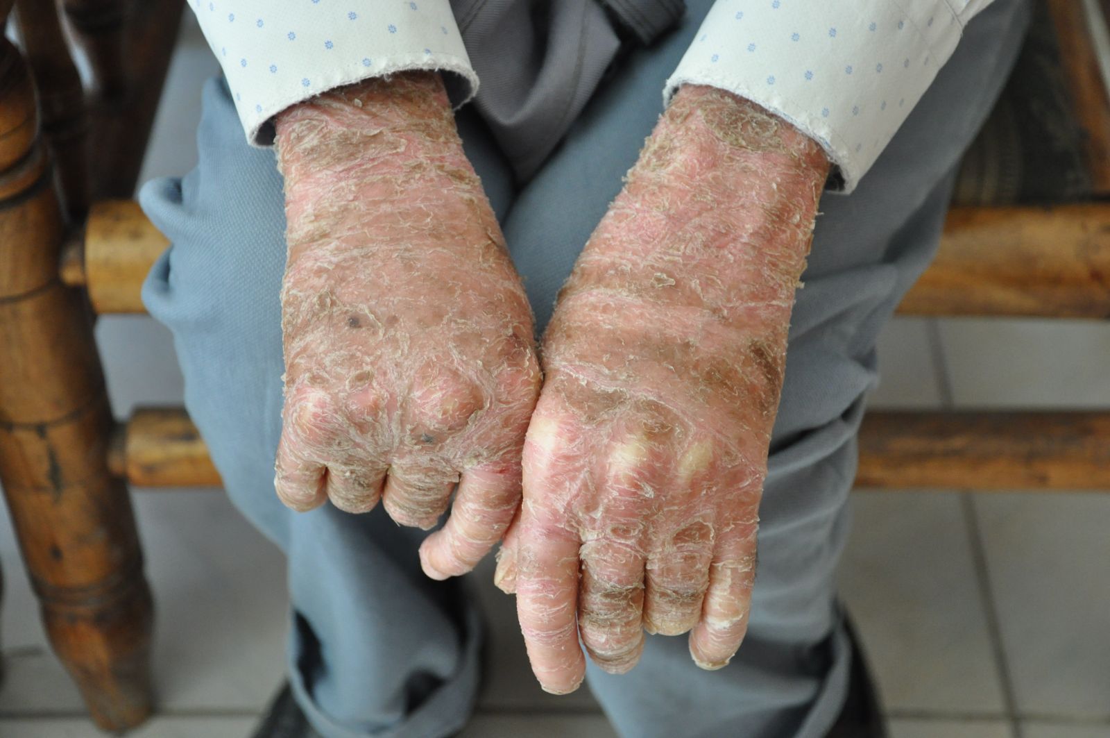 Cilt hastası Töre iyileşmek istiyor