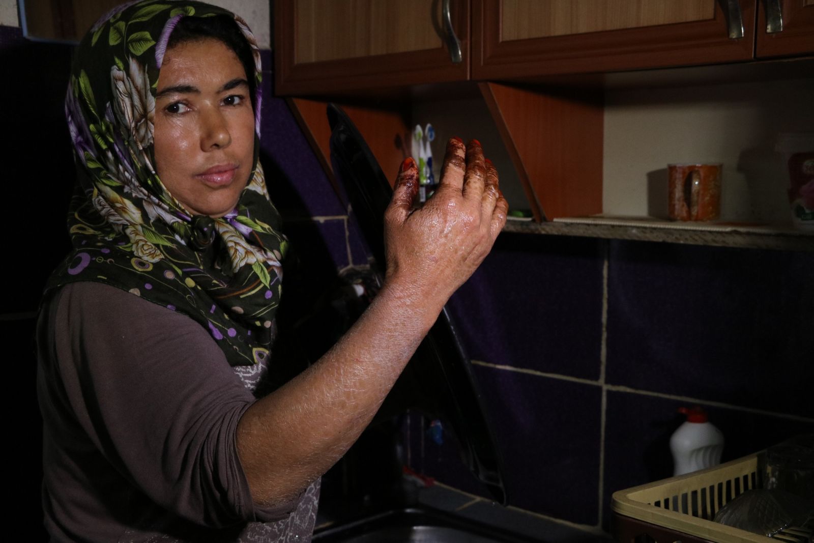 'Balık pulu' hastalığı vatandaşların kabusu oldu