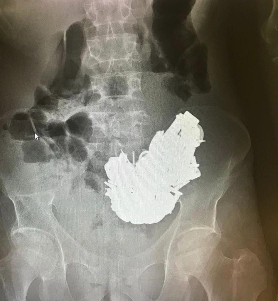 Doktorlar bile şaşırdı: 680 gram metal yutan adam öldü