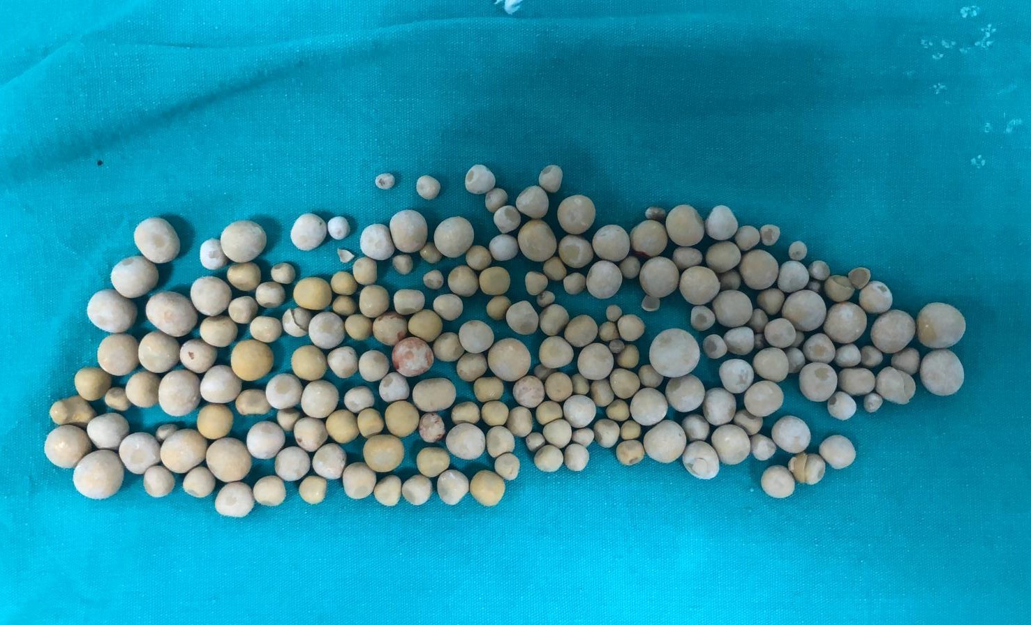 Mesanesinden 199 adet nohut büyüklüğünde taş çıktı