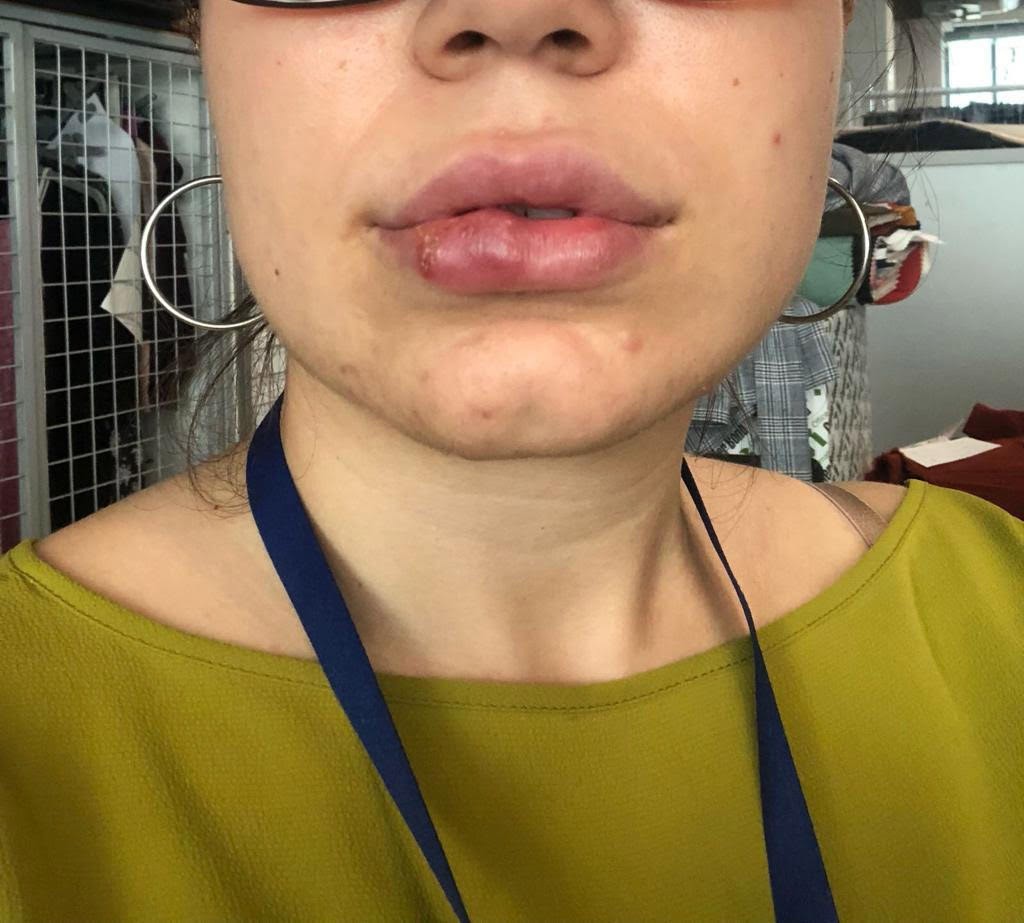 Dudak dolgusu yaptırdı hayatı karardı