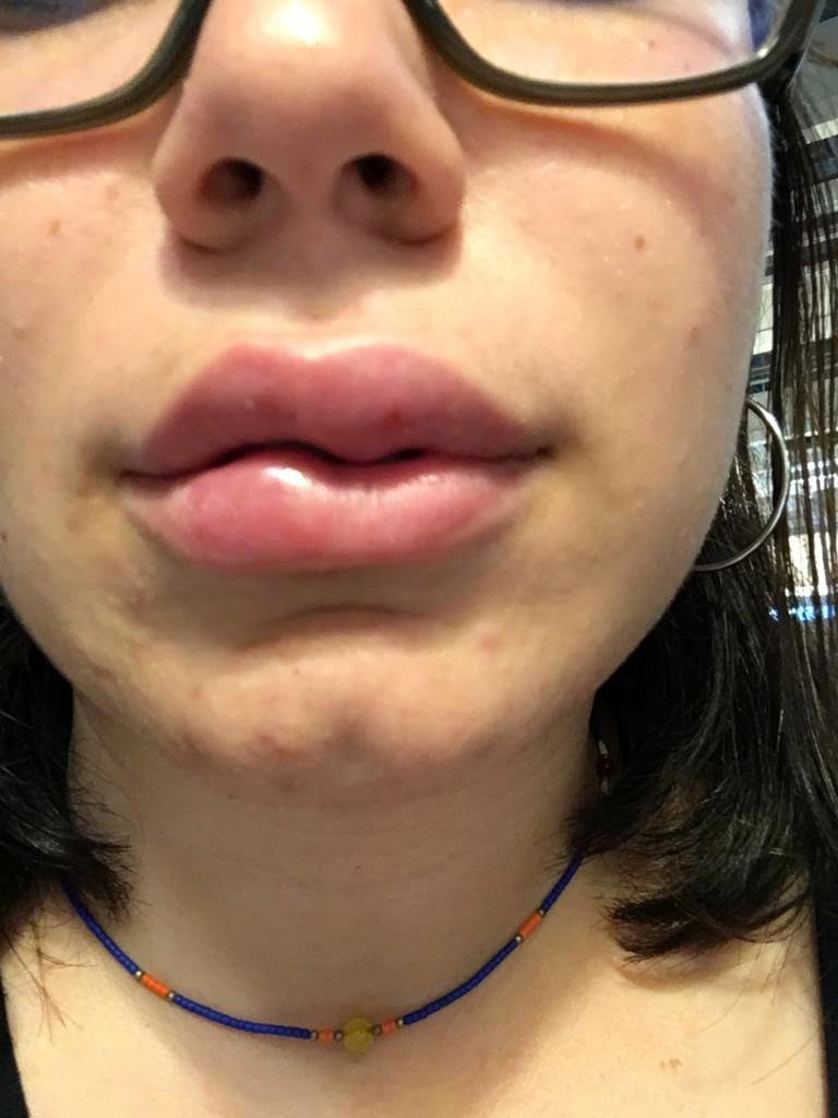 Dudak dolgusu yaptırdı hayatı karardı