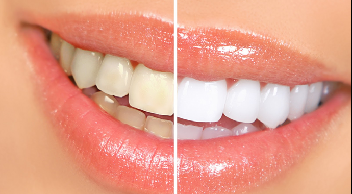 Doğru diş fırçalama teknikleri nasıl olmalı? | Dişler nasıl beyazlatılır?