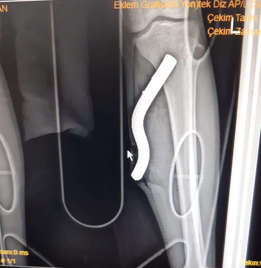 Motosikletin pedalı bacağına saplandı!