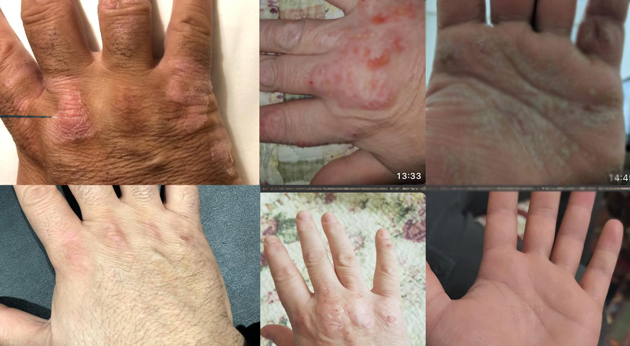 Sedef hastalığına geliştirdiği bitkisel karışımla çare buldu!